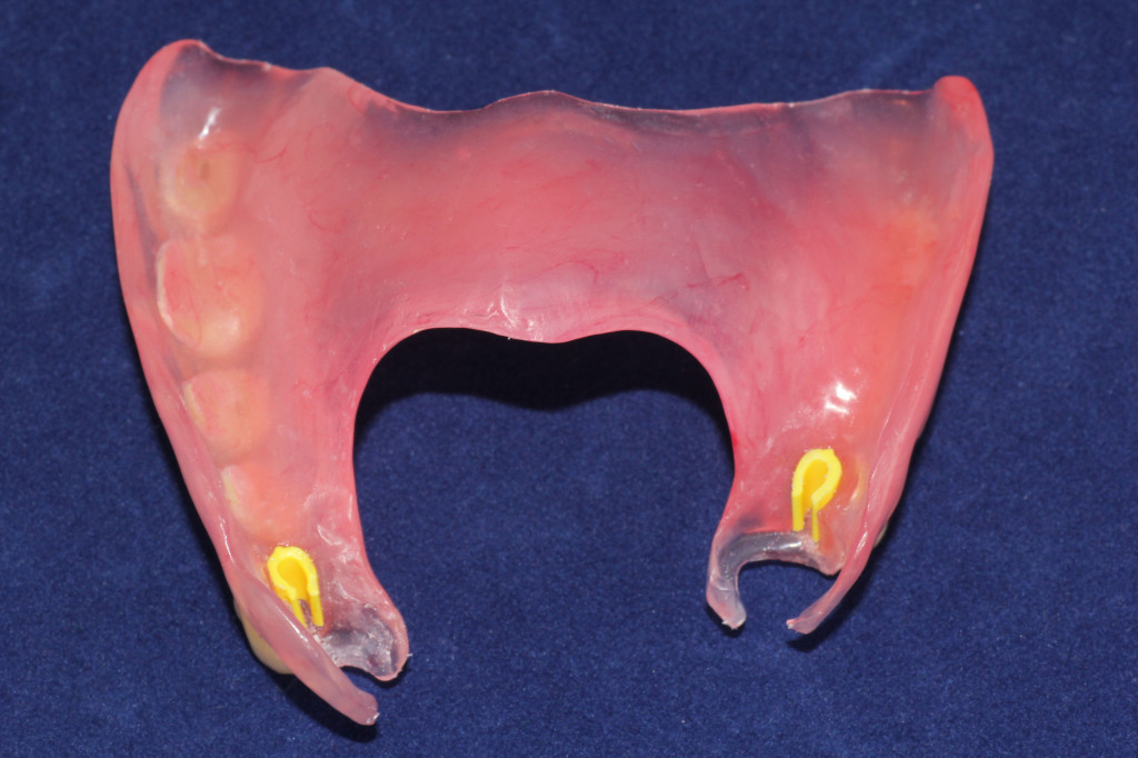 Valplast Prothesen aus Nylon | DENTALLIGENT | Blog