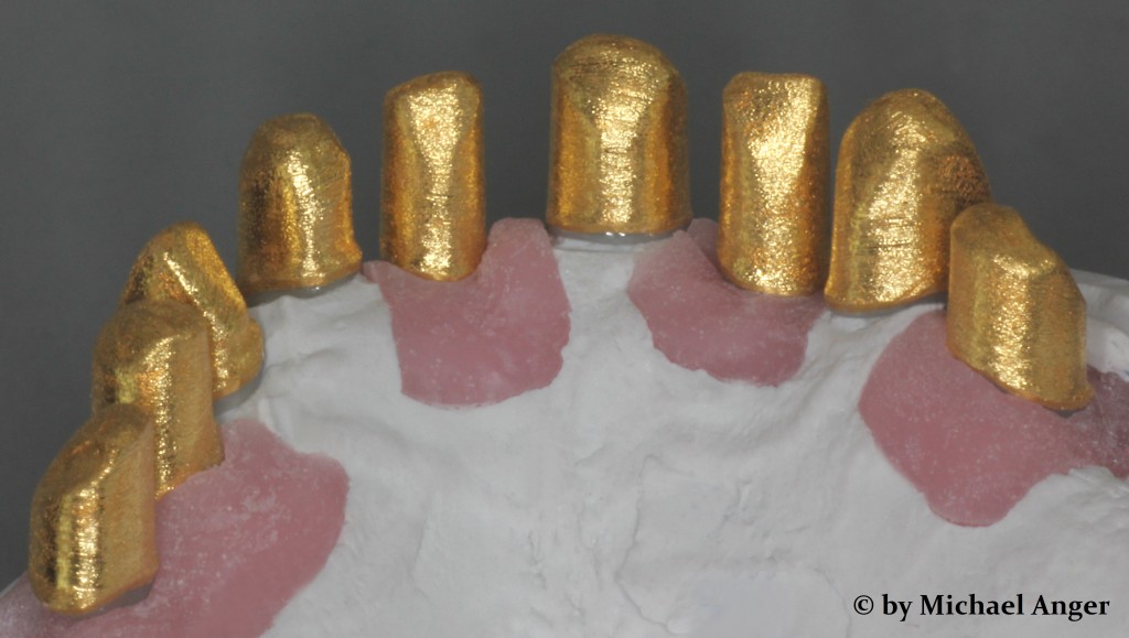 Zirkon & Galvano / Zirconium & Galvano DENTALLIGENT Blog