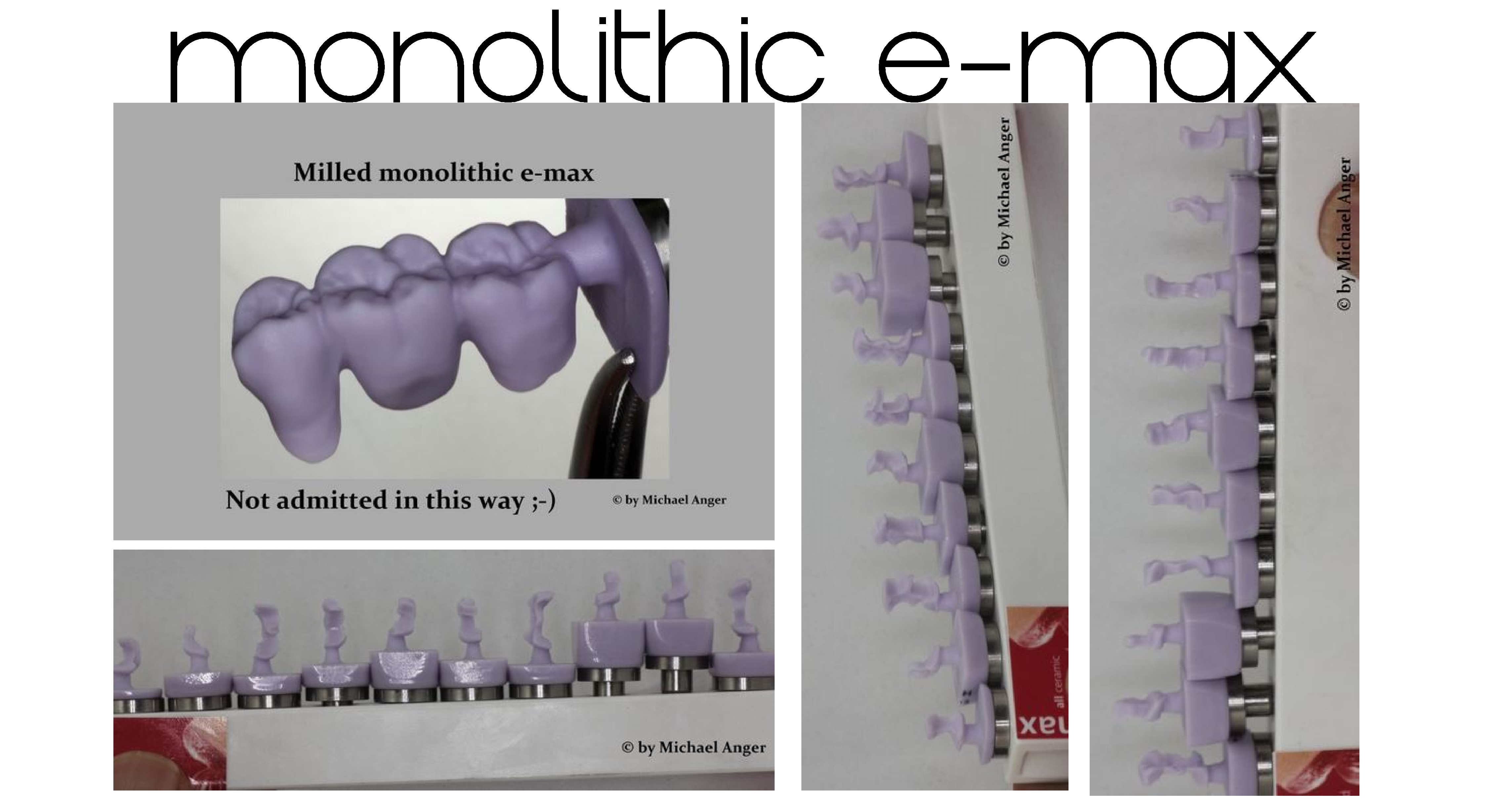Zzzzmonolithic E max DENTALLIGENT Blog