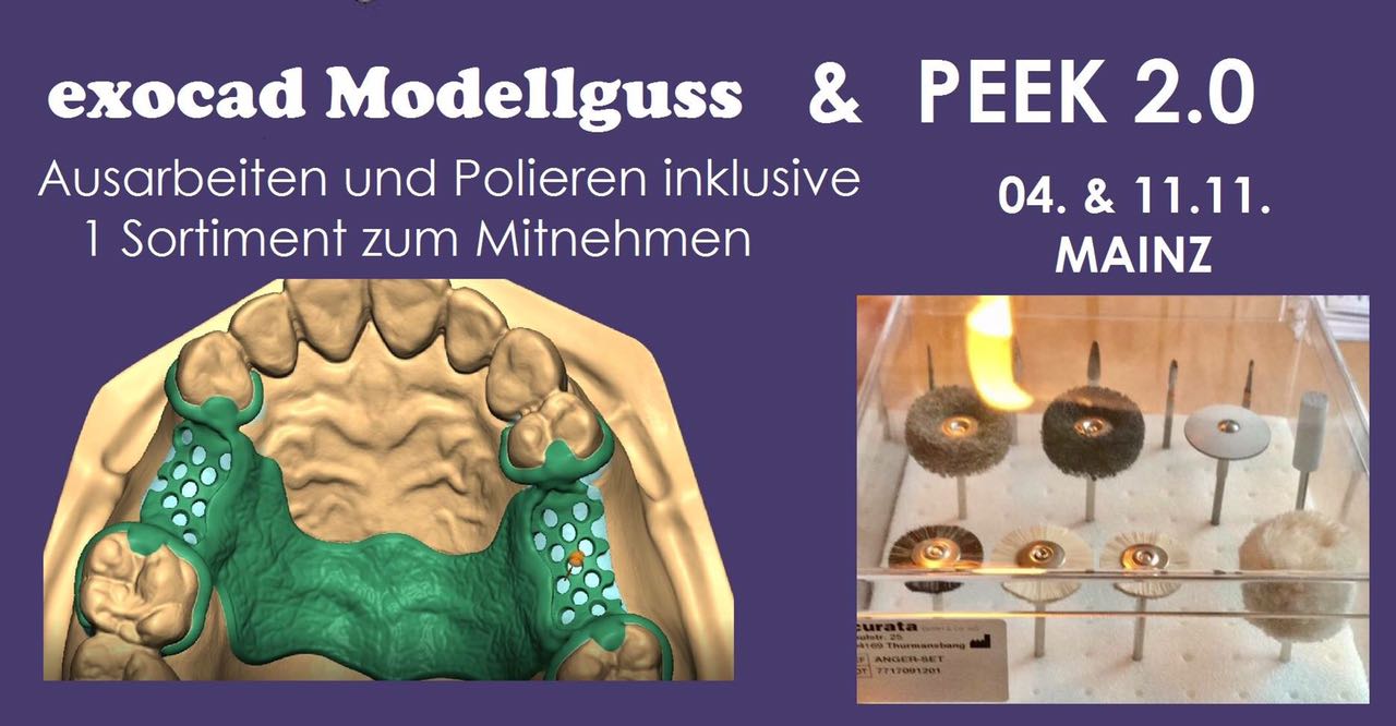 Exocad Modellguss & PEEK 2.0 by Michael Anger