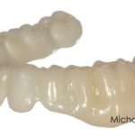 CAD/CAM – Schienen / bitesplints